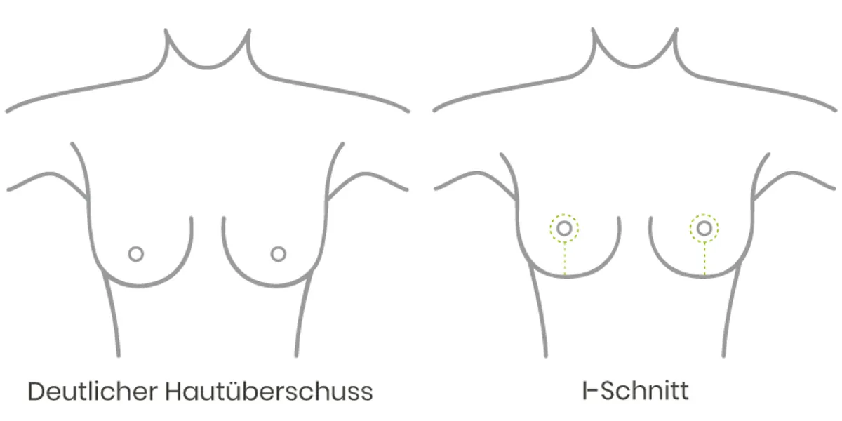 Brustvergrößerung: Wann kann ich wieder einen normalen BH tragen? -  Perfekte Brust®, Brustvergrößerung & Bruststraffung Wien