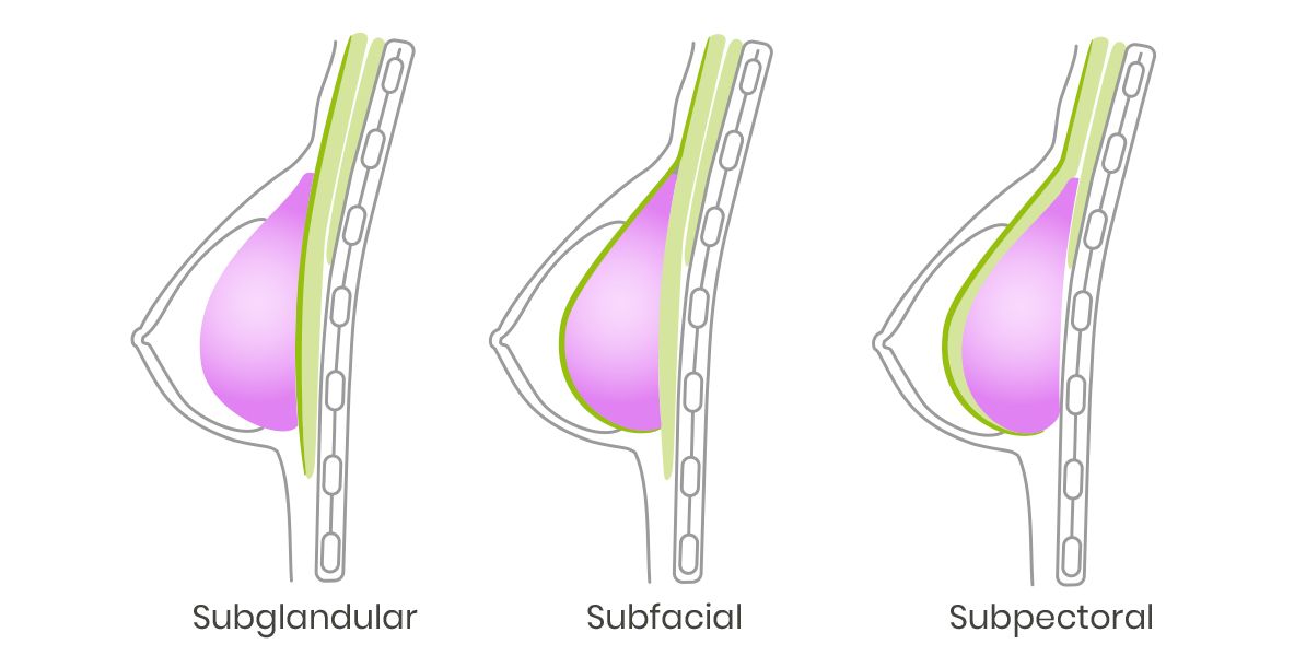 Brustvergrößerung Implantatlage Grafik