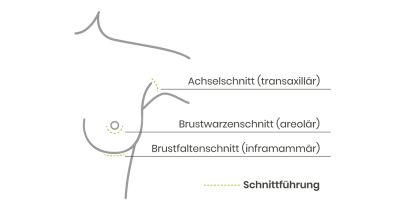 OP Methoden Brustvergrößerung