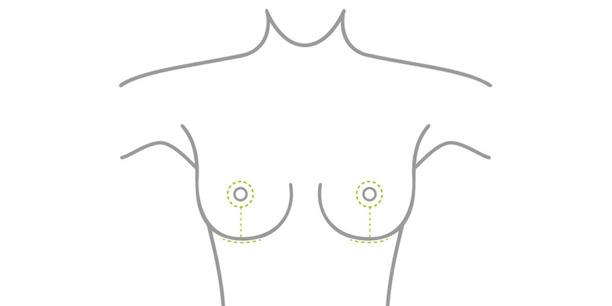 Narbenverlauf bei einer Bruststraffung oder Brustverkleinerung